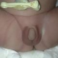 malformations