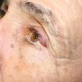 Chalazion