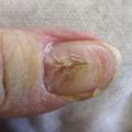 Dystrophie canaliforme de Heller